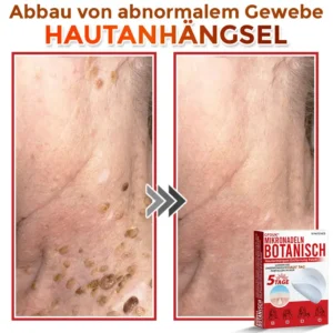 GFOUK® Mikronadeln Botanisch Hautanhängsel Entfernung Patch
