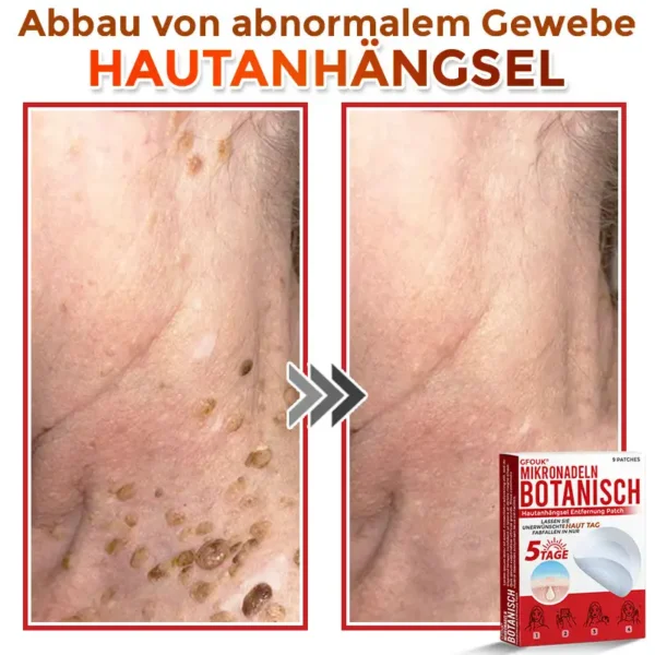 GFOUK® Mikronadeln Botanisch Hautanhängsel Entfernung Patch
